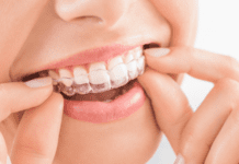 Invisalign vs Braces in Singapore: Which Is Better for You?