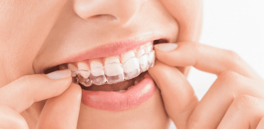 Invisalign vs Braces in Singapore: Which Is Better for You?